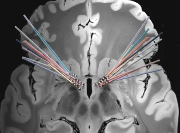 文献速递 | 一种新的强迫症神经生物标志物